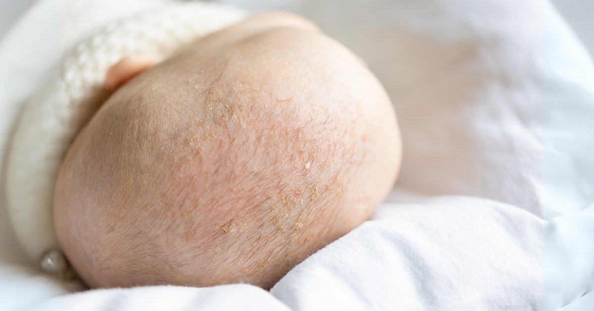 beba sa seboreičnim dermatitisom