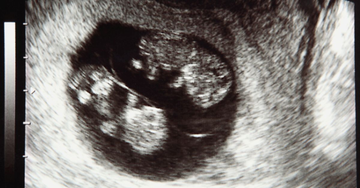 Blizanačka trudnoća viđena ultrazvukom