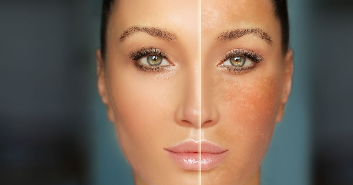 lice žene, polovina sa frlekama, polovina bez