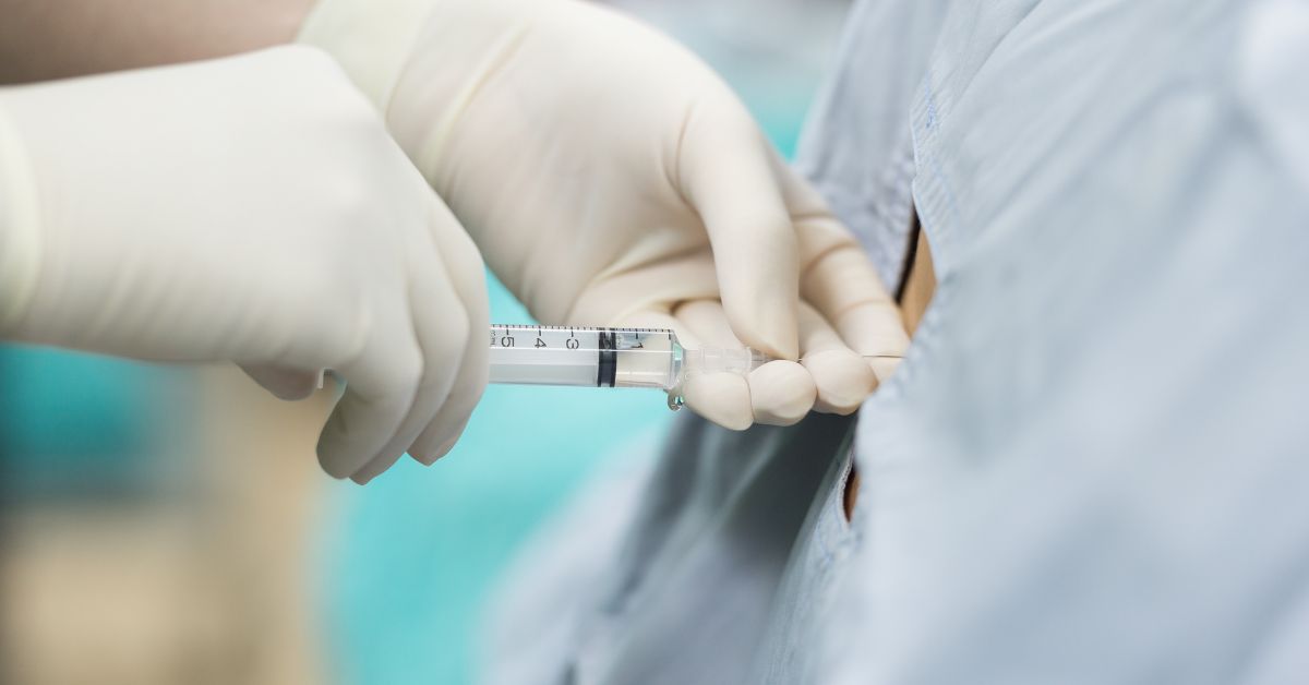 Epiduralna anestezija