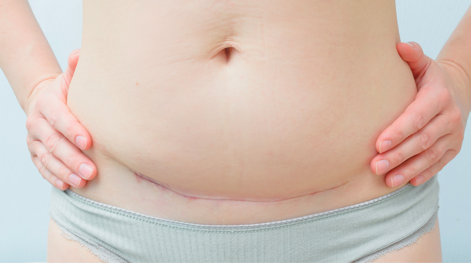 Žđiljak na telu od carskog reza