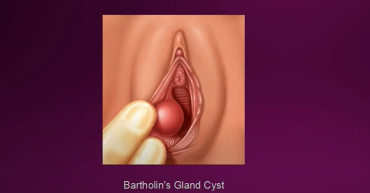 bartolinijeva zlezda prikaz