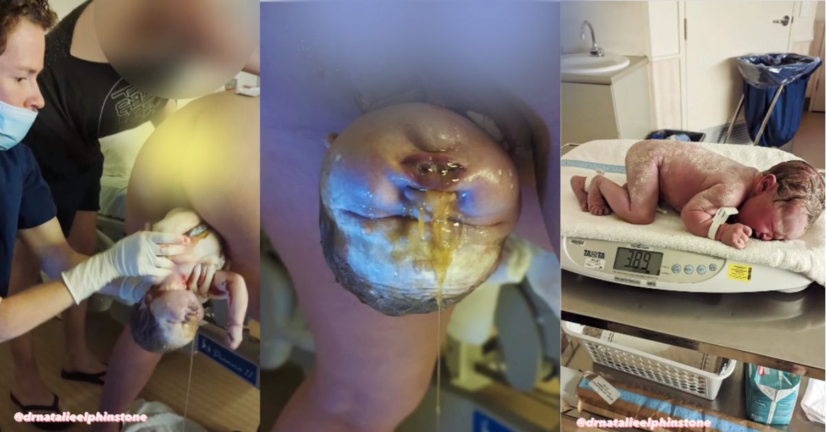 rađanje bebe prirodnim putem