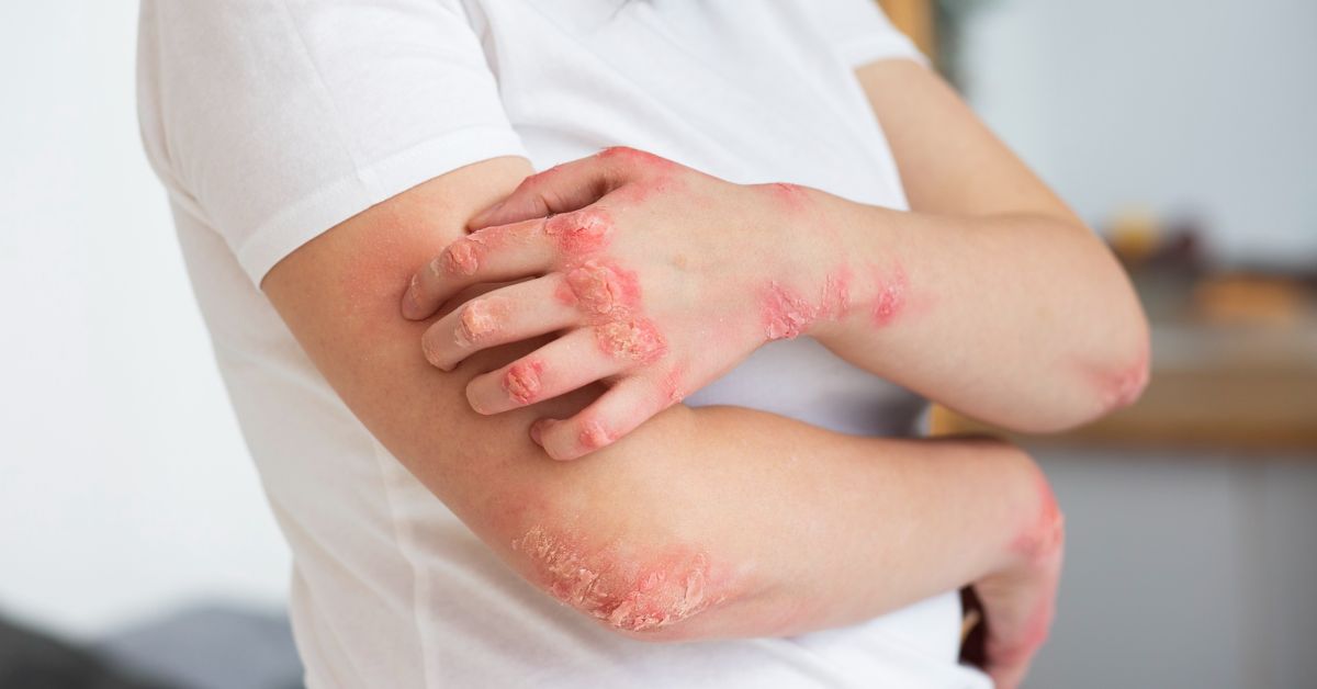 ruke sa atopijskim dermatitisom