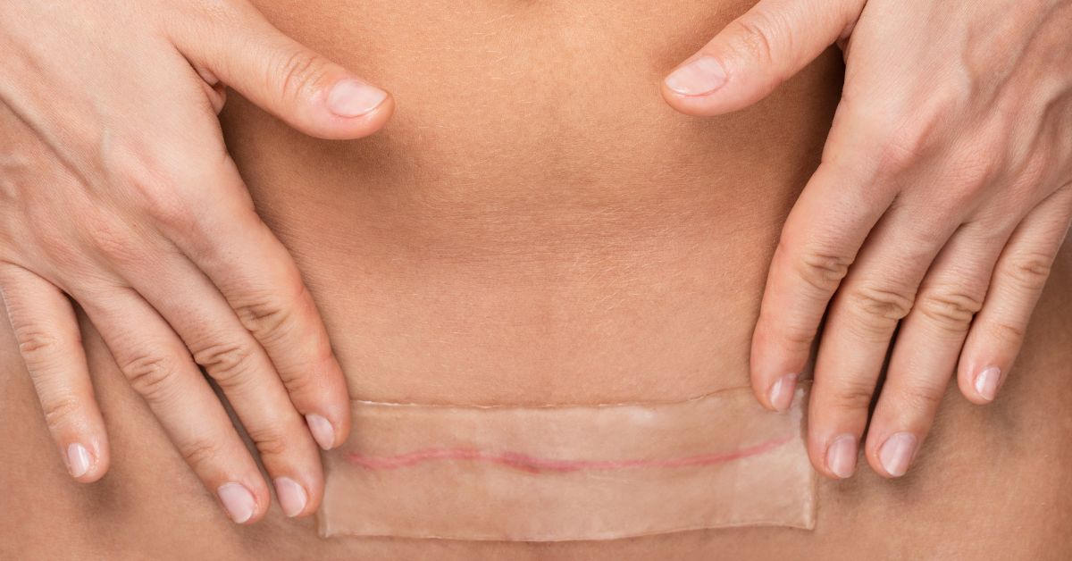 rana od carskog reza