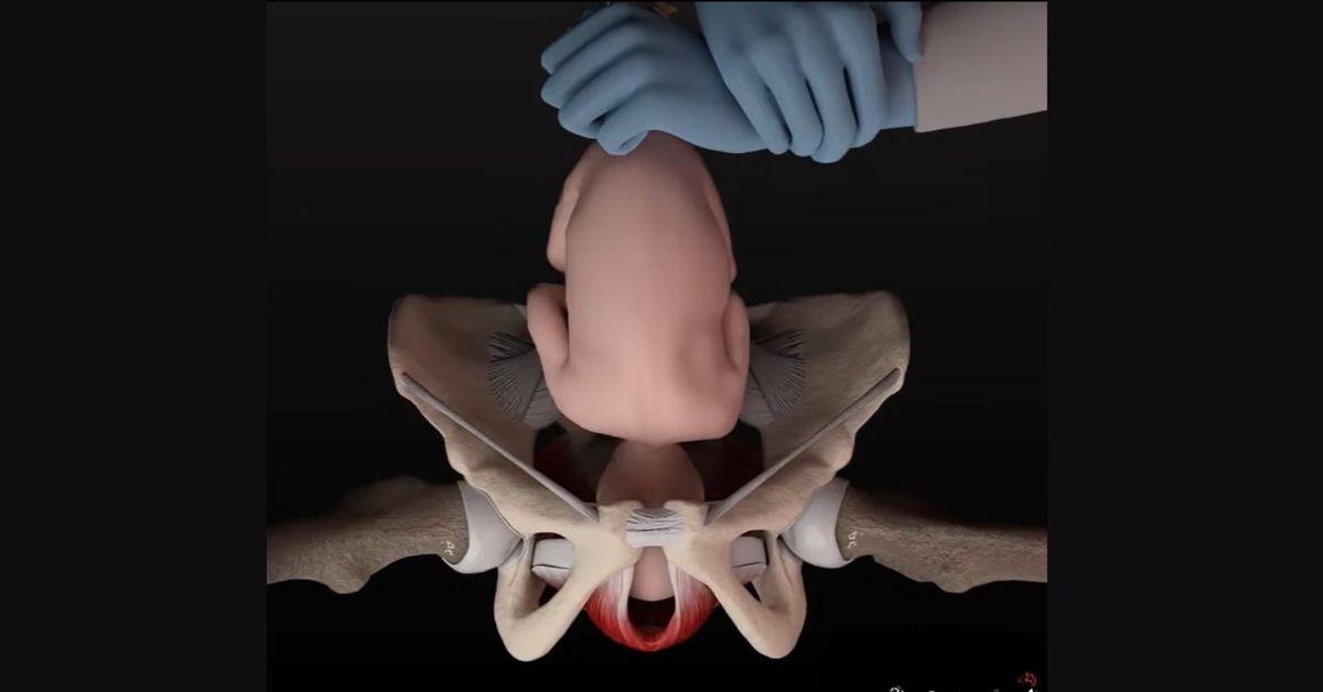 Prikaz medicinske procedure Kristelerov zahvat