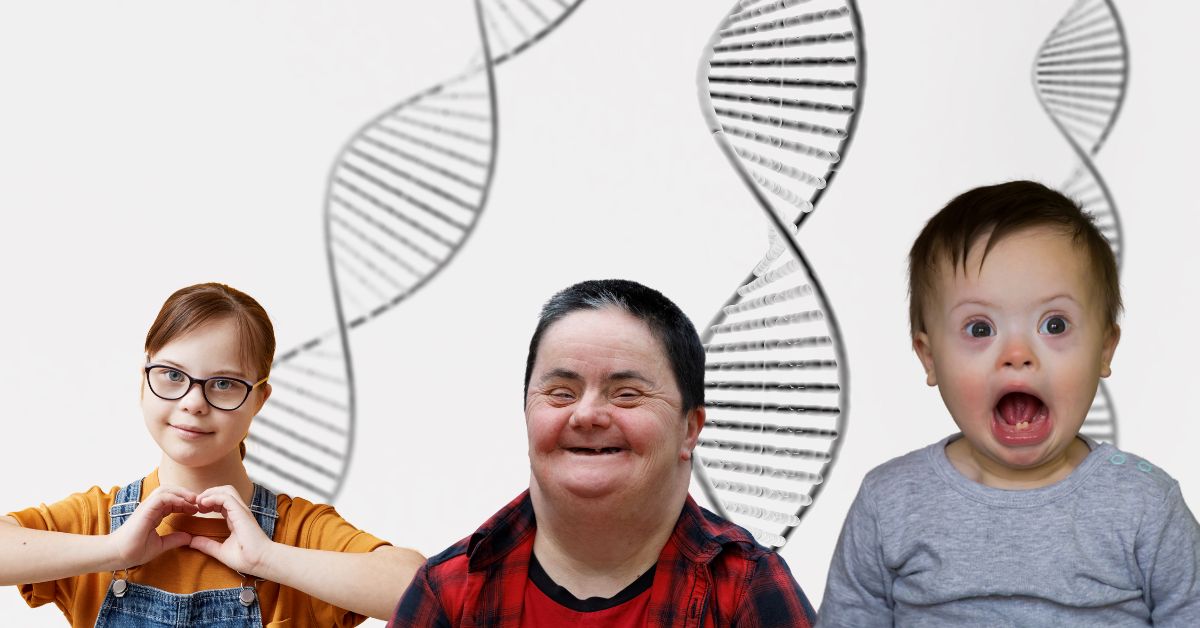 tri osobe sa daunovim sindromom i tri hromozoma