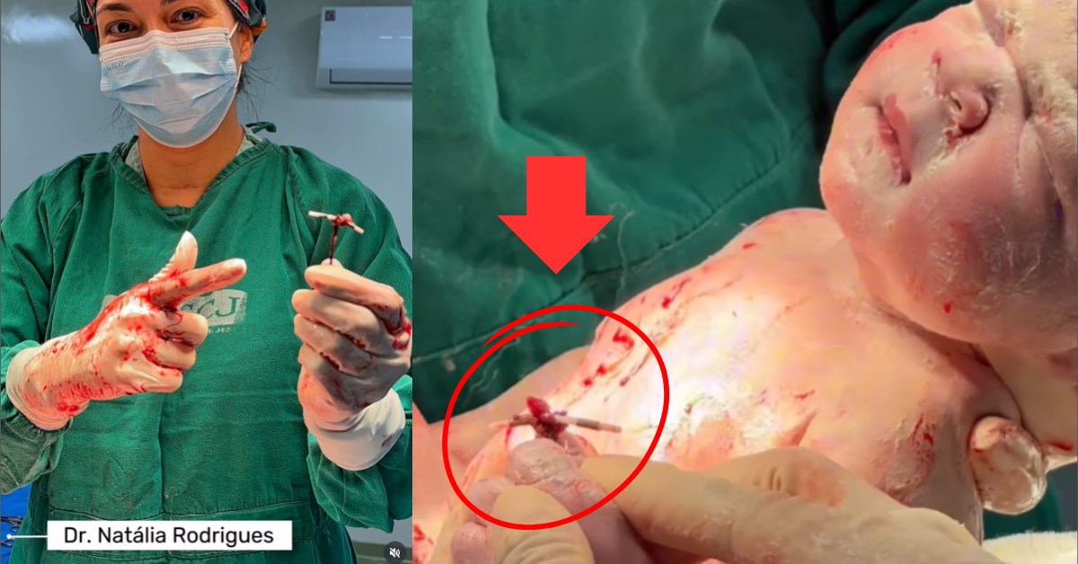 Beba rođena sa spiralom u ruci