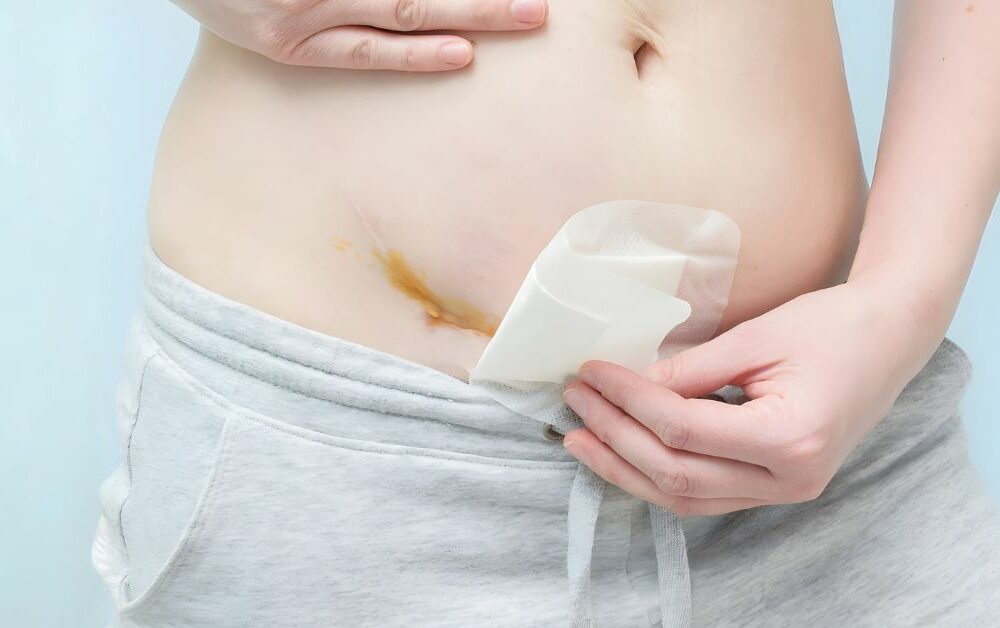 Carski rez rana skidanje zavoja