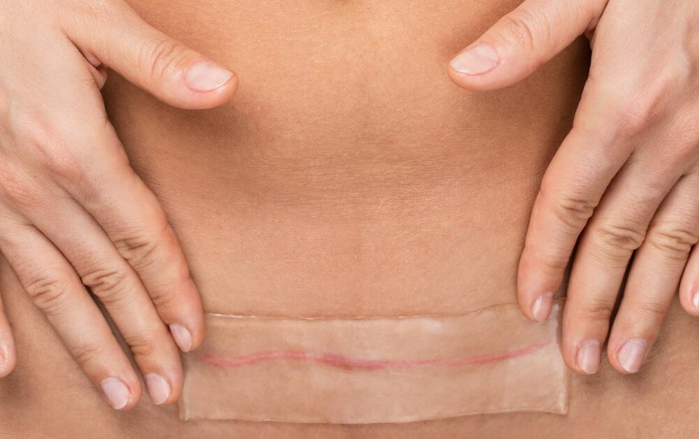 rana od carskog reza